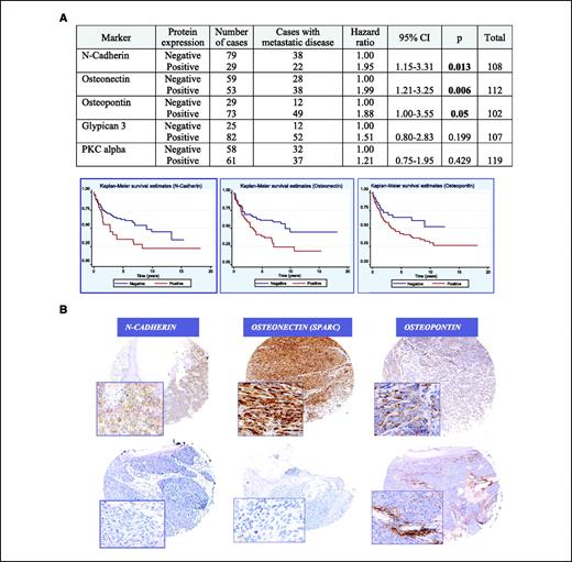 Figure 3. A, Kaplan-Meier analysis of DFS among the validation set of 127 vertical growth phase melanoma cases included in the TMA. The genes evaluated were N-cadherin, osteonectin (SPARC), osteopontin, glypican 3, and PKCα. Kaplan-Meier plots show the curves for significant proteins. 95% CI, confidence interval. B, representative immunohistochemical staining of significantly up-regulated EMT candidate genes identified from the microarray data. Brown staining denotes a positive signal. Magnification, ×4 (inset ×20).