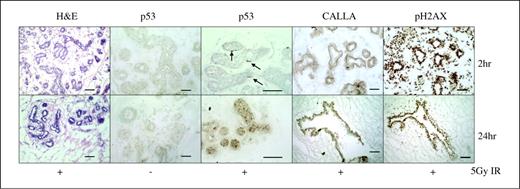 Figure 5. Response of normal ex vivo human mammary tissue to ionizing radiation. Fragments from a reduction mammoplasty were cultured in DFCI overnight before treatment with 5 Gy of ionizing radiation. Multiple fragments at each time point were harvested and embedded in matrix before sectioning. Thin sections were reacted with antibodies to p53, CALLA, and phosphorylated H2AX. H&E-stained sections are shown at 2 and 24 h after ionizing radiation. There is little nuclear accumulation of p53 protein without ionizing radiation treatment. Arrows, basal cells with characteristic nuclear accumulation of p53 protein at 2 h. By 24 h, detectable p53 protein is present primarily in the luminal compartment. CALLA reactivity shows the location of basal cells at 2 and 24 h after ionizing radiation. Staining with phosphorylated H2AX antibody shows intense reactivity in both layers at 2 h after ionizing radiation, whereas at 24 h, reactivity is largely diminished in the basal layer. Full size images are available at http://data.cgt.duke.edu/Basalluminalradiation.php. Bar, 50 μm.