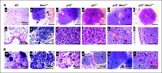 Figure 1. Collaboration between p18 and Men1 in suppression of lung tumors. A, H&E staining of wild-type (WT) lung and lung tumors from different genotypes of mice at 14 to 19 mo of age except for p27−/−;Men1+/− mouse, which was at 12 mo of age. T, tumors. Note the clear tumor borders in p18−/− mouse (c) and the invasive borders in Men1+/− (b and h) and p18−/−;Men1+/− (e) tumors. Black arrows, areas of invasion from the tumor into surrounding lung tissue. Note tumor multiplicity and cell type heterogeneity in (e) and (k). A cluster of mitotic figures (red arrows) and tumor cells (yellow arrow) that invaded into blood vessel (V) are indicated. a to f, lower magnification; g to i, higher magnification. B, representative multiple and heterogeneous lung tumors developed from Men1+/− (m and n) and p18−/−;Men1+/− (o–r) mice. Note the multiple tumors in (m) and (o), tumor cell heterogeneity in (p) and (r), and tumors that obstruct the bronchial/bronchiole lumen (B).
