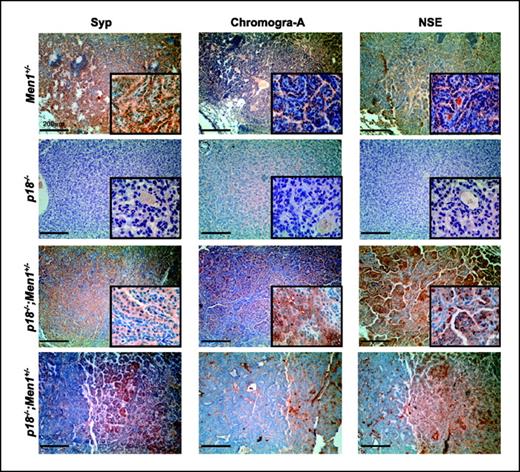Figure 2. p18−/−;Men1+/− lung tumors contain both neuroendocrine and nonneuroendocrine cells. Immunostaining of the lung tumors for synaptophysin (Syp), Chromogranin A (Chromogra-A), and neurospecific enolase (NSE). Insets, magnified images. Note the heterogeneous staining in tumors from Men1+/− and p18−/−;Men1+/− mice. Bottom row, lung carcinoma from p18−/−;Men1+/− mice containing both neuroendocrine-positive and -negative cells.