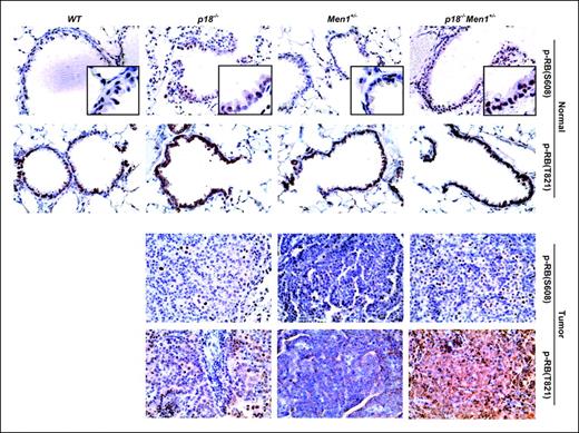 Figure 4. Combined p18 and Men1 mutations stimulate pRb phosphorylation at CDK sites. Sections of normal (top two rows) and tumorigenic (bottom two rows) lungs of different genotypes of mice at 14 to 19 mo of age were examined for pRb protein phosphorylation at two CDK sites, Ser608 phosphorylated by CDK4 and CDK6 and Thr821 phosphorylated by CDK2. Counterstainings are in blue and positive stainings are in brown.