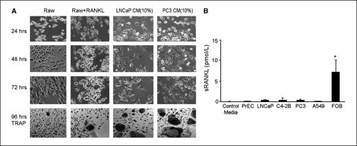 Figure 1. Prostate cancer conditioned medium induced osteoclastogenesis, and RANKL in the conditioned medium was at minimum levels. A, single-cell suspensions (3 × 104 cells per well) of RAW 264.7 cells were plated in a 96-well plate in DMEM plus 10% FBS. Cells were grown for 12 h, and then, the medium was changed to DMEM plus 0.5% FBS. Conditioned medium from PrEC, LNCaP, C4-2B, PC3, and lung cancer A549 cells was harvested (as described in Materials and Methods) and added to a final concentration of 10% (v/v). Osteoclasts were identified as TRAP-positive multinucleated (more than three nuclei) cells. Representative micrographs of cultures for 24, 48, and 72 h. At 96 h, the cells were stained for TRAP. B, levels of sRANKL in control medium, PrEC, LNCaP, C4-2B, PC3, A549, and FOB cells were measured by ELISA. Columns, mean of triplicates; bars, SD. *, P < 0.005, compared with control medium.