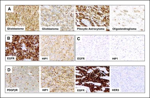 Figure 1. HIP1 expression in brain tumor tissue. Tissue microarrays constructed from normal and neoplastic brain tissues were stained for HIP1 using the human monoclonal antibody HIP1/4B10. Multiple spots from each tumor were scored as follows: 0 (no staining), 1+ (low staining), 2+ (intermediate staining), and 3+ (high staining) by at least two independent observers. An overall positive score was assigned when the average score between reads was ≥2. A, glioblastoma multiforme (Glioblastoma) with all tumor cells 3+ for HIP1 staining; glioblastoma multiforme with 50% of the tumor cells 3+ for HIP1 staining; pilocytic astrocytoma 3+ for HIP1 staining; and oligodendroglioma with 1+ low staining for HIP1 except for the endothelial cells of blood vessels. B, EGFR-positive and HIP1 3+ high-grade glioblastoma multiforme. C, EGFR-negative, HIP1-negative glioblastoma multiforme. D, PDGFβR-positive, HIP1-positive, EGFR-positive, and HER3-negative glioblastoma multiforme.