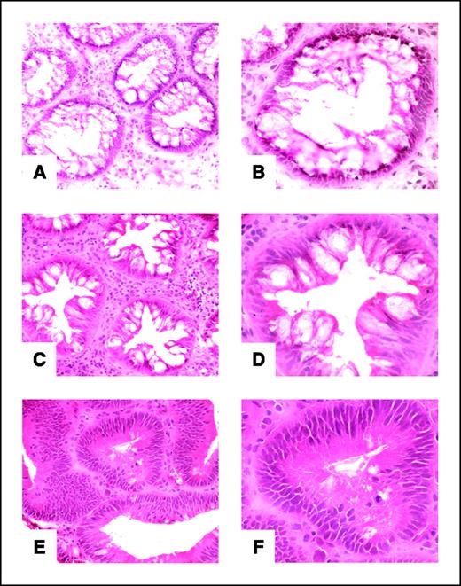 Figure 1. Histology of ACF. H&E-stained frozen sections of the three categories of ACF: non-serrated hyperplastic (A and B), serrated hyperplastic (C and D), and dysplastic (E and F). A, cross-section through an enlarged circular or oval upper crypt of a KRAS-mutated, non-serrated hyperplastic ACF that exhibit numerous goblet cells (B, detail). C, cross-section through a BRAF-mutated, serrated ACF that shows an enlarged crypt with a stellate lumen (serrated on longitudinal section). D, detail of the component epithelial cells of the serrated ACF to consist of a mixture of goblet cells and columnar cells that have a microvesicular cytoplasm. E and F, section through the upper crypts of a dysplastic ACF to show enlarged irregularly shaped crypts that are lined by cells with mucus-depleted cytoplasm and nuclei that are stratified, elongated, and dysplastic in appearance.