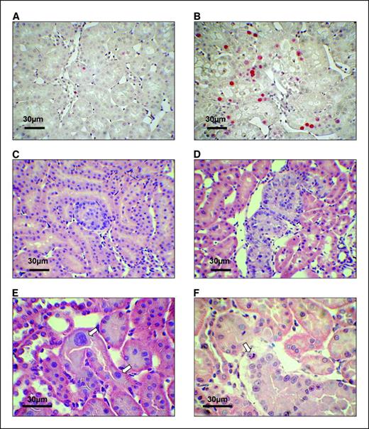 Figure 2. Representative PCNA staining patterns of control (A) and OTA-treated (B) Eker rats. C, atypical tubule. D, atypical hyperplasia. Karyomegally (E; arrows) and apoptotic nuclei (F; arrow) observed in OTA-treated rats.
