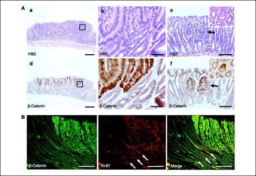 Figure 2. Gastric tumors in ApcMin/+ mice show adenomatous lesions with nuclear/cytoplasmic accumulation of β-catenin. A, H&E-stained sections (a–c) and immunostaining for β-catenin on serial sections (d–f). Strong nuclear immunostaining for β-catenin was recognized in the adenomatous glands, whereas the adjacent hyperplastic glands only revealed membranous staining. Note that the small lesion (c) already shows β-catenin accumulation (f). c and f, arrow, small adenomatous lesion. Bars, 200 μm (a and d), 50 μm (b and e), and 100 μm (c and f). B, proliferating Ki-67–positive cells increase in the adenomatous glands with nuclear/cytoplasmic β-catenin accumulation, whereas surrounding hyperplastic glands include positive cells only at proliferative compartment (arrows). Bar, 100 μm.