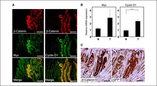 Figure 3. Increased β-catenin/Tcf transcriptional activity in the adenomatous lesions of the stomach in ApcMin/+ mice. A, double immunofluorescent staining for β-catenin, Myc, or cyclin D1. β-Catenin accumulation (red) is colocalized (yellow) with Myc (left; green) and cyclin D1 (right; green) overexpressions in the adenomatous glands within the tumor. B, increased mRNA expression of Myc and cyclin D1 in the gastric tumors of ApcMin/+ mice. The expression of each gene was examined by quantitative real-time RT-PCR and normalized to β-actin expression. N, normal epithelium (n = 10); T, tumor (n = 10). Columns, mean of three independent experiments; bars, SE. **, P < 0.01, Mann-Whitney U test. C, β-catenin/Tcf reporter mice show GFP (right) expression in adenomatous glands with β-catenin accumulation (left). Bar, 100 μm (A and C).