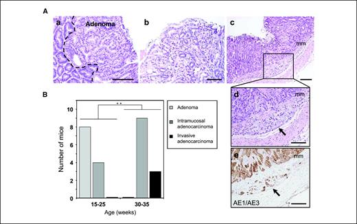 Figure 5. Gastric tumors in MNU-treated ApcMin/+ mice show more aggressive lesions. A, histopathologic features of gastric tumors in MNU-treated ApcMin/+ mice. a, adenomas in MNU-treated ApcMin/+ mice were similar to that in ApcMin/+ mice. Dotted line, border between hyperplastic and adenomatous (Adenoma) lesion. b, intramucosal adenocarcinomas with distinctive cellular and structural atypia. c, several gastric adenocarcinomas showed invasion into the submucosa. d, higher magnification of the boxed section in (c). e, invasive undifferentiated cells expressed an epithelial marker, AE1/AE3. mm, muscularis mucosae. Bar, 100 μm. B, histologic grade of the most advanced tumor in tumor-bearing MNU-treated ApcMin/+ mice. The histologic grade of the tumors progressed over time. Columns, number of mice with each histologic type. **, P < 0.01, Spearman's rank correlation test.