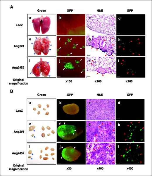 Figure 2. Overexpression of Ang2 by MCF-7 breast cancer cells promotes tumor metastasis in mice. MCF-7 parental cells were obtained from ATCC. Various MCF-7 cell lines were generated to stably express Ang2 or LacZ and GFP with no observable alterations in cell properties (see Materials and Methods in the Supplementary Data). A and B, tumor metastasis was examined by gross observation (a, e, and i) and epifluorescent observation of GFP (b, f, and j). Cryosections were further examined by epifluorescence (d, h, and l) followed by H&E staining (c, g, and k). Mice that received MCF-7/Ang2/GFP cells (clone 1 or 52) showed metastasis in the lung and lymph nodes (e–l in A and B) with high incidence. Grossly visible metastases (blue arrowheads) in the lung (e and i in A) and lymph nodes (e and i in B) were identified as green foci (f and j, white arrowheads) and micrometastatic cells expressing GFP (h and l, red arrowheads) and by H&E staining (g and k, red arrowheads). Bars, 120 μm (b, c, d, f, g, h, j, k, and l in A), 600 μm (b, f, and j in B), and 30 μm (c, d, g, h, k, and l in B). The experiments in (A) and (B) were done three independent times and similar results were obtained. Additionally, these experiments were also done twice using Ang2#4 (low expression of Ang2) and Ang2#5 (high expression of Ang2; Supplementary Fig. S1A) in mice. High incidence of lymph node and lung metastasis was found in mice that received Ang2#5 cells, whereas no tumor metastasis was found in mice that received Ang2#4 cells.