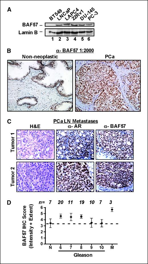 Figure 1. BAF57 is highly expressed in human prostate cancer specimens. A, immunoblotting was performed for BAF57 and lamin B (loading control) in the LNCaP, LAPC4, 22Rv1, DU-145, and PC-3 prostate cancer cells. BT549 cells were used as the negative control. B, nonneoplastic (left) and primary (right) human prostate cancer (PCa) specimens were analyzed by immunohistochemistry for BAF57 using the generated antisera (BAF57, 1:2,000 dilution). C, independent lymph node (LN) metastases of prostate cancer were stained by standard H&E (left) and immunostained for AR (middle) or BAF57 (right). D, immunohistochemical (IHC) staining was performed for BAF57 on a TMA slide containing ∼80 cores. n, number for each category. BAF57 immunohistochemical score is displayed as a composite of intensity + extent of tumor staining as indicated in Materials and Methods. X axis, Gleason scores. M, lymph node metastatic samples.
