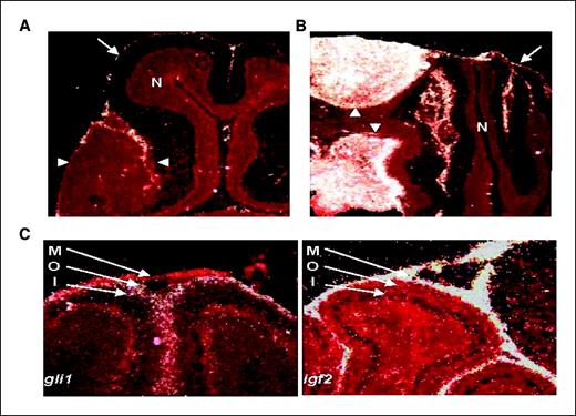 Figure 2. Expression of igf2 in developing cerebella and MB. A and B, in situ hybridization studies of early MB (A) and advanced MB (B) using a probe specific to igf2. Signal from hybridized probe seems white. Tissue is counterstained in red. In each panel, tumor is outlined by arrowheads. Igf2 transcript is not seen in early MB (A) but is seen at high levels in the advanced MB (B). Igf2 transcript is not seen in normal cerebellum (N) but is observed in the meninges (arrows) surrounding the cerebellum. C, in situ hybridization studies of P7 cerebella using probes specific to igf2 or gli1. Igf2 transcript is observed in the meninges (M) but not in the outer (O) or inner (I) EGL. Conversely, the Shh target transcript gli1 is absent from the meninges but is seen in the outer, but not inner EGL.