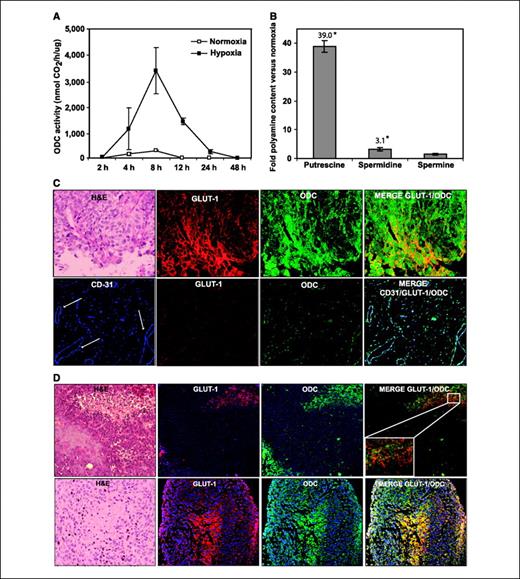 Figure 2. Hypoxic induction of ODC activity and polyamines in vitro and increased ODC protein in hypoxic tumor regions in vivo. A, transient induction of ODC activity by hypoxia. HeLa cells were incubated in normoxia or hypoxia for the indicated times and cell lysates were analyzed for ODC activity as described in Materials and Methods. Representative of two independent experiments. Points, mean; bars, SD. B, HeLa cells were incubated in normoxia or hypoxia as described in A, and cell lysates from the 12-h time point were analyzed for the content of the polyamines putrescine, spermidine, and spermine as described in Materials and Methods. *, P < 0.05, versus normoxic control. C, hypoxic regions in cervical cancer samples display increased ODC protein levels. Serial cross sections of formalin-fixed and paraffin-embedded patient tumor specimens were stained with H&E or analyzed by immunofluorescence microscopy using GLUT-1 (hypoxia marker), ODC, or CD31 (endothelial cell/blood vessel marker) antibodies. Top, necrotic tumor area. Bottom, nonhypoxic, vascularized area. D, top, similar staining as in C was done on serial sections of U-87 MG glioma cell tumors established in immunodeficient mice. ODC co-associates with GLUT-1 in proximity to the necrotic tumor area. Representative pictures of nine cross sections from three separate tumors. Bottom, increased ODC expression was shown in the central, hypoxic region of C6 glioma cell spheroids. Representative photomicrographs obtained at ×40 (C) and ×20 (D) magnifications. Red, green, and blue, GLUT-1, ODC, and CD31 stainings, respectively.