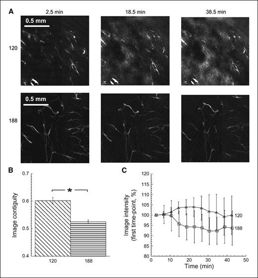 Figure 4. In vivo multiphoton fluorescence imaging of VEGF120- and VEGF188-expressing tumors growing in window chambers in SCID mice. A, maximum projection images from two tumors at different times (midpoint of the time frame for image acquisition) following i.v. injection of 40 kDa of FITC-dextran. Extensive leakage of FITC-dextran from the tumor vasculature into the interstitium could be seen with time in the VEGF120-expressing tumor but not in the VEGF188-expressing tumor. B, image contiguity (columns, mean; bars, SE) at the first time point after injection of FITC-dextran (2.5 min) for the whole tumor group (n = 5–7 tumors in each group). Contiguity was significantly higher in VEGF120 tumors than in VEGF188 tumors (*, P = 0.0005; Student's t test for unpaired data). C, the kinetics of FITC-dextran leakage for the whole tumor group. Intensities were averaged gray levels in whole three-dimensional images of each tumor, normalized to the first time point (mean for n = 5–7 tumors in each group; bars, 1 SE). The curves for the two groups were significantly different (P < 0.05, MANOVA with repeated measures).
