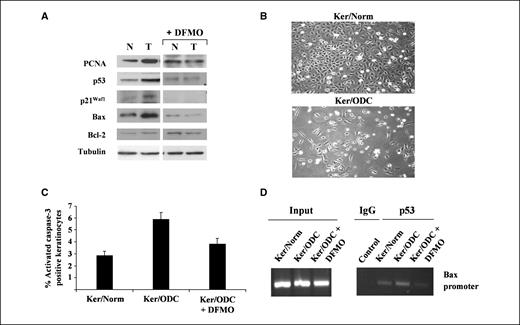 Figure 1. Polyamine-dependent p53 protein accumulation and apoptotic cell death in ODC-overexpressing primary keratinocytes. Primary keratinocytes were isolated from K6/ODC transgenic mice (T) and their normal littermates (N) and plated. Some of the K6/ODC keratinocytes were treated with 3 mmol/L DFMO. A, after 5 d in culture, cells were harvested in RIPA buffer and equal amounts of protein were resolved by SDS-PAGE and transferred to PVDF membranes. PCNA, p53, p21Waf1, Bax, and Bcl-2 were detected by immunoblotting, and the membranes were reprobed for tubulin protein as a loading control. B, representative photomicrographs of Ker/Norm and Ker/ODC following 6 d in culture. C, keratinocytes were stained immunohistochemically using an anti–caspase-3 (active form) antibody. The values for the percent caspase-3–stained keratinocytes are the percentages of caspase-3–stained cells out of the total cells per coverslip. At least 1,000 total cells were counted per group. D, the Bax promoter was assessed by ChIP analysis for p53 binding in cross-linked protein-DNA complexes precipitated from Ker/Norm, Ker/ODC, and Ker/ODC + DFMO–treated keratinocytes using an anti-p53 antibody or rabbit IgG as a control. PCR was performed with primers specific for the Bax promoter, which included the p53 binding site. To verify equal amounts of starting material, PCR was performed on aliquots of the chromatin removed before immunoprecipitation (Input). Amplified DNA was visualized by agarose gel electrophoresis.