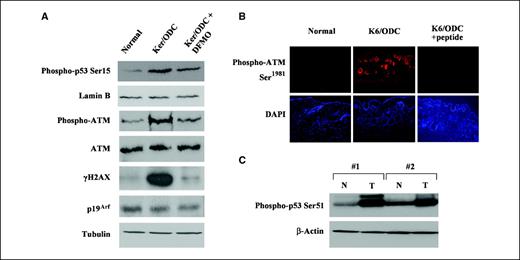 Figure 2. ODC overexpression activates ATM in primary keratinocytes and in K6/ODC transgenic skin. A, primary keratinocytes were isolated from K6/ODC transgenic mice (Ker/ODC) and their normal littermates (Ker/Norm) and plated. Some of the Ker/ODC were treated with 3 mmol/L DFMO. Nuclear extracts and RIPA lysates were prepared and equal amounts of protein were resolved by SDS-PAGE and transferred to PVDF membranes. Nuclear extracts were probed for phospho-p53 (Ser15) and lamin B. Total cellular lysates were probed for ATM, γH2AX, and p19Arf by immunoblotting and then reprobed for tubulin protein as a loading control. B, immunofluorescence of normal littermate skin and K6/ODC transgenic mouse skin using an antibody specific for ATM phosphorylated at serine-1981 (pATM) in the presence or absence of a peptide for ATM phosphorylated at Ser1981. DAPI was used for the same views to identify all nuclei. C, normal and K6/ODC skins were resolved by SDS-PAGE, transferred to PVDF, and probed for phospho-p53 (Ser15) and β-actin by immunoblotting.