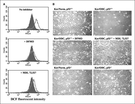 Figure 6. DFMO and MDL 72,527 prevent H2O2 generation in primary keratinocytes and increase survival of Ker/ODC. Primary keratinocytes were isolated from K6/ODC transgenic mice and their normal littermates as well as from K6/ODC transgenic mice and normal littermates bred to a p53−/− background. Some Ker/ODC were cultured with 3 mmol/L DFMO or 25 μmol/L MDL 72,527 in the medium. A, the levels of H2O2 production in Ker/Norm (shaded curve) and Ker/ODC (open curve) treated with and without 3 mmol/L DFMO and 25 μmol/L MDL 72,527 were compared using flow cytometry. Four days following culture, cells were incubated with 10 μmol/L CM-H2DCFdA at 37°C for 25 min, and fluorescence was measured using a BD FACS Canto II flow cytometer. X axis, fluorescent intensity; Y axis, cell number. B, representative phase contrast images were taken of the keratinocytes after 14 d in culture to capture the difference in survival between Ker/Norm and Ker/ODC treated with and without 3 mmol/L DFMO and 25 μmol/L MDL 72,527. Whereas no viable Ker/ODC, p53+/+ remained by 7 d in culture, Ker/ODC, p53−/− were still proliferating after 14 d of culture.