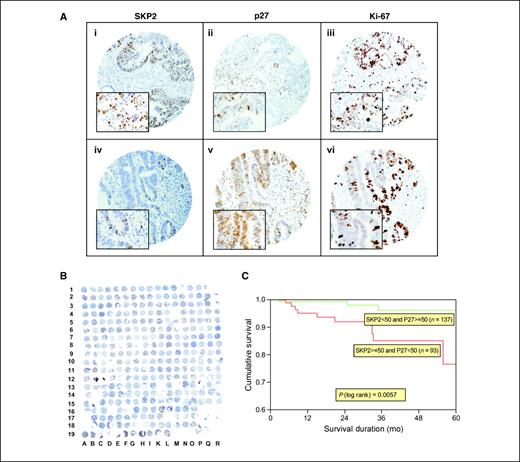 Figure 1. Tissue microarray–based expression analysis of SKP2, p27Kip1, and Ki-67 in CRC. A, representative tissue microarray spots demonstrating immunohistochemical staining of colorectal carcinoma. Tumor cells of a colorectal carcinoma exhibiting (i) SKP2 overexpression, (ii) loss of p27Kip1 expression, and (iii) overexpression of proliferative marker Ki-67. Spot of another colorectal carcinoma exhibiting (iv) normal expression of p27Kip1, (v) low SKP2, and (vi) low levels of Ki-67. Original magnification, ×400; inset, high-power magnification, ×1,000. B, an overview of CRC tissue microarray section stained for SKP2. C, the association between SKP2 and p27Kip1 expression groups and overall survival. Analyses were constructed with the Kaplan-Meier method. Overall survival was analyzed by stratifying the patients in two groups: normal SKP2/normal p27 group versus Skp2 overexpression and low p27Kip1 expression. n, number of patients.
