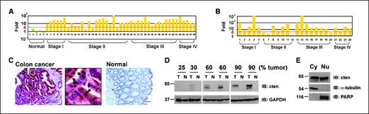 Figure 1. Cten expression and distribution in colon cancer patients. A, quantitative PCR analysis of cten transcripts in 5 normal colon and 43 cancer samples from four disease stages. Number labels in X-axis indicate different patients. B, ratio of cten expression in colon cancer/adjacent normal tissues in 24 matched pairs of patient samples. C, representative cten immunohistochemical staining in colon cancer and normal specimens. Boxed area in colon cancer sample (left) is enlarged and shown in the middle. Arrows, presence of cten staining in nuclei. Bar, 100 μm. D, six matched pairs of colon cancer (T) and adjacent normal tissue (N) lysates (30 μg each) from patients with different percentage of tumor lesion were immunoblotted (IB) with indicated antibodies. Cten degradation was observed in some samples. E, the cytoplasmic (Cy) and nuclear (Nu) fractions (40 μg each) from the fifth colon cancer patient sample shown in D were immunoblotted with indicated antibodies. α-Tubulin and poly(ADP-ribose) polymerase (PARP) antibodies were used to confirm no cross-contamination between two fractions.