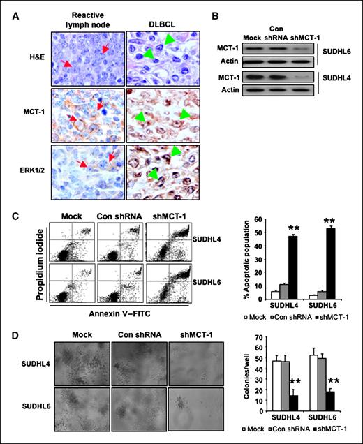 Figure 1. Knockdown of MCT-1 by shRNA induces apoptosis and reduces their clonogenic capacity. A, immunostaining of DLBCL shows MCT-1 and ERK1/2 expression in reactive germinal center B-cell centroblasts (arrows) and DLBCL cells (arrowheads; original magnification, ×1,000). Top, MCT-1 staining; bottom, ERK staining. B, SUDHL4 and SUDHL6 cells were transduced with a lentivirally encoded MCT-1 shRNAs (hairpin no. 3; shMCT-1) and control shRNA (Con). MCT-1 expression was monitored by Western blot analysis. Mock indicates nontransduced cells. C, at 72 h after transduction, cell apoptosis was measured via Annexin V and propidium iodide staining. Flow cytometric profile was showed in the left panel. Columns, mean of three independent experiments; bars, SD. ANOVA was determined by Student's t test relative to control shRNA. **, P < 0.01. D, SUDHL4 and SUDHL6 cells were transduced with shMCT-1 and control shRNA. On day 9, colony formation was examined and photomicroscopy of SUDHL4 and SUDHL6 cell colonies was taken in soft-agar plates at ×10 magnification (left). Right, quantification of anchorage-independent growth. The colony numbers were counted in each well of SUDHL6 and SUDHL4 cell colonies. Columns, mean of four experiments; bars, SEM.