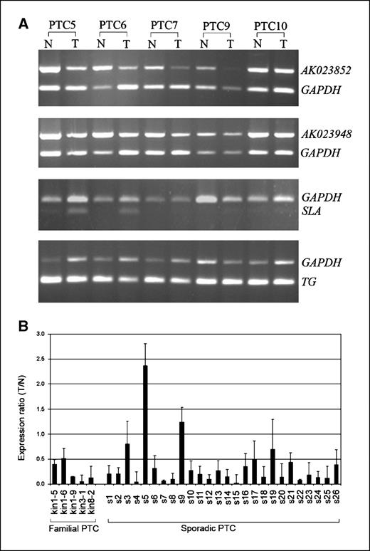 Figure 4. Gene expression analysis in PTC. A, semiquantitative RT-PCR of AK023852, AK023948, SLA, and TG in five sporadic PTC samples from which tumor (T) and paired unaffected thyroid tissue (N) were analyzed. GAPDH was used as an internal control. B, quantitative real-time RT-PCR of AK023948 in familial and sporadic PTC samples. GAPDH was used as control. The expression ratio (T/N) of PTC tumor (T) versus paired unaffected normal (N) was calculated by the comparative threshold cycle method; columns, mean; bars, SD.