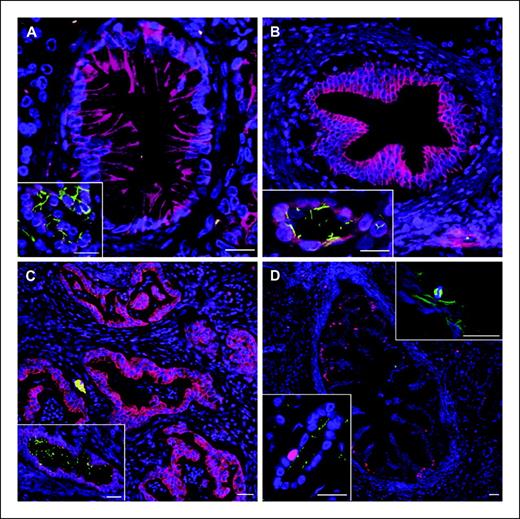 Figure 1. Primary cilia are absent in human PDAC and PanIN lesions. A, PanIN-1. B, PanIN-2. C, poorly differentiated PDAC. D, PanIN-2/3. A to D, blue, nuclei. A to C, red, CK19; green, acetylated α-tubulin. D, red, Ki67; green, α-tubulin. Insets: A to D, bottom left, nonneoplastic ducts from adjacent normal region within respective specimens; top right, region of neoplastic ductal epithelium taken at 150% gain and power, revealing a mitotic figure and cytosolic tubules, with absence of ciliary projections. Bar, 20 μm.