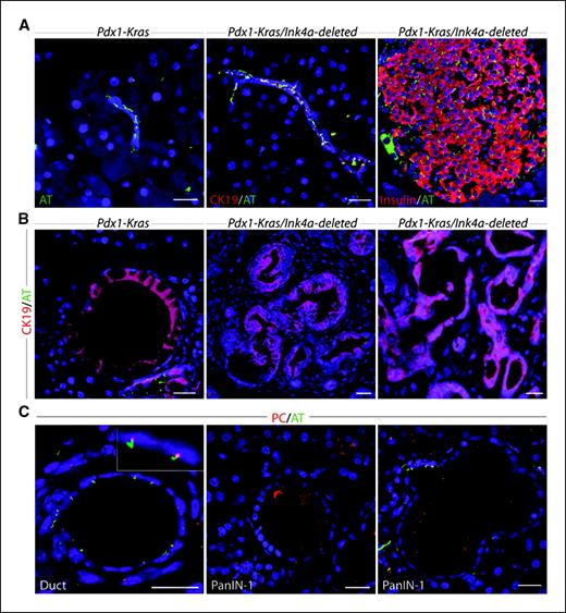 Figure 2. Primary cilia are absent in Kras-dependent murine pancreatic neoplasia. A, left, centroacinar cells from Pdx1-Cre; middle, LSL-KrasG12D (Pdx-Kras) and normal ductule and islet from Pdx1-Cre; right, LSL-KrasG12D;Ink4a/Arflox/lox (Pdx-Kras/Ink4a–deleted) murine pancreata. B, left, mPanIN-1 from Pdx-Kras; middle, mPanIN-2/3 from Pdx-Kras/Ink4A–deleted murine pancreata; right, murine pancreatic cancer from same tissue sample as in middle image. C, centrosomes, stained with an anti-pericentrin antibody, and primary cilia in normal and neoplastic ducts from Pdx1-Cre;LSL-KrasG12D pancreata. Inset, magnified view of cilia and centrosomes from cells immediately below the inset. Staining for CK19, acetylated α-tubulin (AT), insulin, and pericentrin (PC), as indicated. Bar, 20 μm.