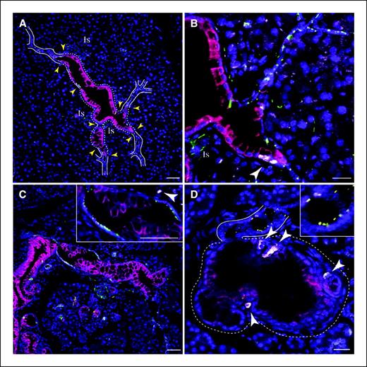 Figure 3. Primary cilia are absent in transitional PanIN lesions. A, intralobular mPanIN from Pdx1-Cre;LSL-KrasG12D pancreas reveals normal-appearing ductal epithelium (solid white lines) and neoplastic ductal epithelium (dashed lines). Yellow arrowheads, transition points between normal and neoplastic epithelia. Is, islets. Red, CK19; green, AT; blue, nuclei. Bar, 50 μm. B, magnified region from A, stained as in A, but with anti-Ki67 antibody in white (white arrowhead). Bar, 50 μm. C, interlobular mPanIN from a Pdx1-Kras pancreas. Staining as in A. Bar, 20 μm. Inset, magnified region from C with addition of Ki67 channel in white (white arrowhead). Bar, 50 μm. D, mPanIN from Nestin-Cre;LSL-KrasG12D pancreas stained for CK19 (red), AT (green), and Ki67 (white arrowheads), revealing the terminal cul-de-sac–like architecture (dashed lines) of a mPanIN lesion appearing to arise from a small ductule (solid lines). Inset, magnified view of ciliated normal ductule from within main image. Bar, 20 μm.