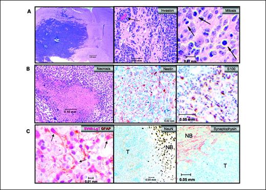 Figure 3. Characterization of NRAS/SV40-LgT–induced tumors. A, representative images of histology including clustering of tumor cells around capillaries and mitotic figures (black arrows). B, representative images of necrosis, nestin, and S100 IHC are shown. C, two-color IHC staining for GFAP in brown and SV40-LgT in pink (arrows, some dual positive cells; left). Other panels show that the bulk tumor (T) is negative for neuronal markers NeuN and synaptophysin, whereas normal brain (NB) is strongly positive by IHC.