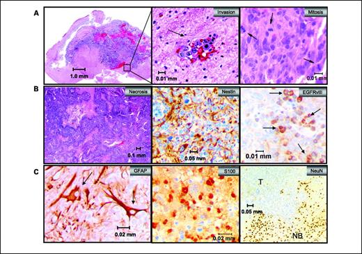 Figure 5. Characterization of the NRAS/shP53/EGFRvIII model. A, large tumor in the right hemisphere infiltrating the left hemisphere (left). Middle, ×20 magnification of region marked by the black box in A showing single cell infiltrates invading normal brain tissue. Right, representative mitotic figures (arrows). B, representative images of pseudopalisading necrosis, nestin, and EGFRvIII IHC are shown (black arrows, few EGFRvIII-positive cells). C, representative images of GFAP, S100, and NeuN staining are shown where T marks the bulk tumor mass and NB marks normal brain.