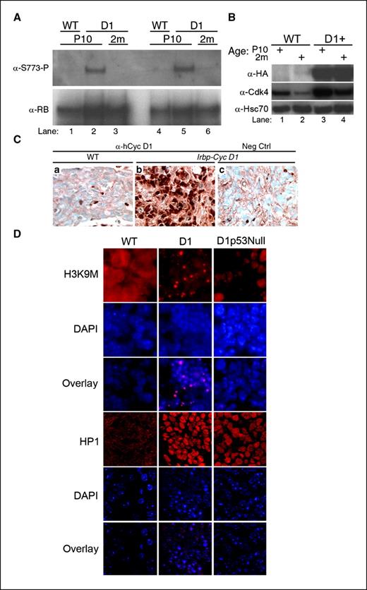 Figure 2. RB hypophosphorylation despite continued cyclin D1 expression in aging Irbp-cyclin D1 mice. A, immunoprecipitation and Western blotting for total RB and phospho-Ser773 in mouse RB from two representative pineal glands of WT (lanes 1 and 4) and transgenic (lanes 2, 3, 5, and 6) mice at P10 (lanes 1, 2, 4, and 5) and 2 mo (2m; lanes 3 and 6). B, Western blotting reveals the indicated proteins in pineal gland lysates from WT (lanes 1 and 2) and transgenic (lanes 3 and 4) mice at P10 (lanes 1 and 3) and 2 mo (lanes 2 and 4). HA, HA epitope tag of transgenic cyclin D1. C, immunohistochemical staining for human cyclin D1 at P49 in WT (a) and transgenic (b and c) pineal gland. Negative control was stained without the primary antibody. D, immunofluorescence staining for H3-K9M and HP1γ with corresponding DAPI staining in WT, Irbp-cyclin D1, and Irbp-cyclin D1, p53−/− pineal glands at P49. H3-K9M images are taken at ×400 magnification and HP1γ at ×1,000 magnification with a confocal microscope.