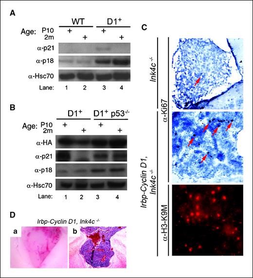 Figure 5. p18Ink4c preserves cell cycle arrest and blocks PNET progression in Irbp-cyclin D1 mice. A and B, Western blotting reveals the indicated proteins in pineal gland lysates from mice of the indicated genotypes at P10 and 2 mo. HA, HA epitope on the human cyclin D1. C, immunohistochemical staining for the proliferation marker Ki67 (top and middle) and heterochromatin-associated H3-K9M (bottom) in the pineal gland of the indicated mice at P49. D, representative photomicrographs showing Irbp-cyclin D1, Ink4c−/− pineal gland tumor in whole mount (a) and following H&E staining (b).