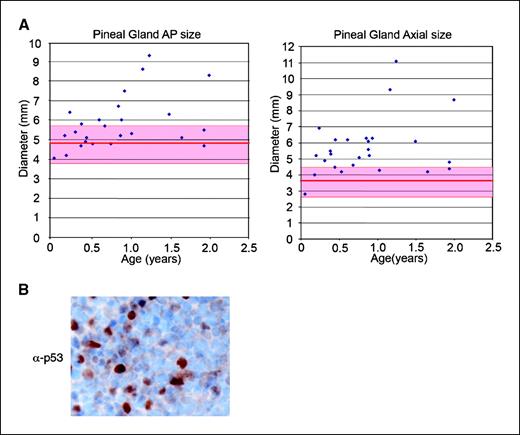 Figure 6. Pineal gland enlargement is observed in children with heritable RB. A, graphical representation of pineal gland size in children with bilateral RB. Individual points correspond to anteroposterior (AP) and axial dimensions of pineal gland from magnetic resonance images at time of RB diagnosis. Red line and shaded area denotes normal average and SD in pineal gland size for children below 2 y of age (20). B, immunohistochemical staining for p53 in the tumor of the one patient developing pineal gland PNET.