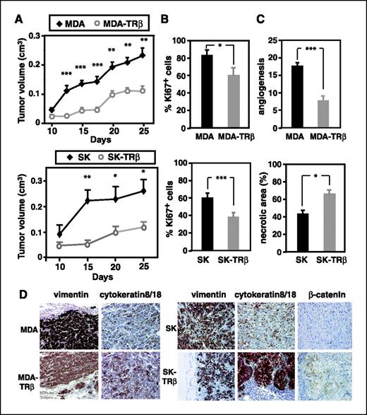 Figure 1. TRβ1 inhibits tumor growth and causes a partial mesenchymal-to-epithelial transition. A, nude mice were injected with parental and TRβ1-expressing hepatocarcinoma (SK) and breast cancer (MDA) cells, and tumor volume was measured at different time points after inoculation. B, tumors were excised at 30 d, and the percentage of cells expressing Ki67 was determined. C, TRβ1 reduced tumor angiogenesis, determined by counting the number of neoformed blood vessels/field (top), and increased the necrotic area determined from trichromic staining (bottom). Columns, mean; bars, SE. D, immunohistochemical staining for vimentin, cytokeratin 8/18, and β-catenin.