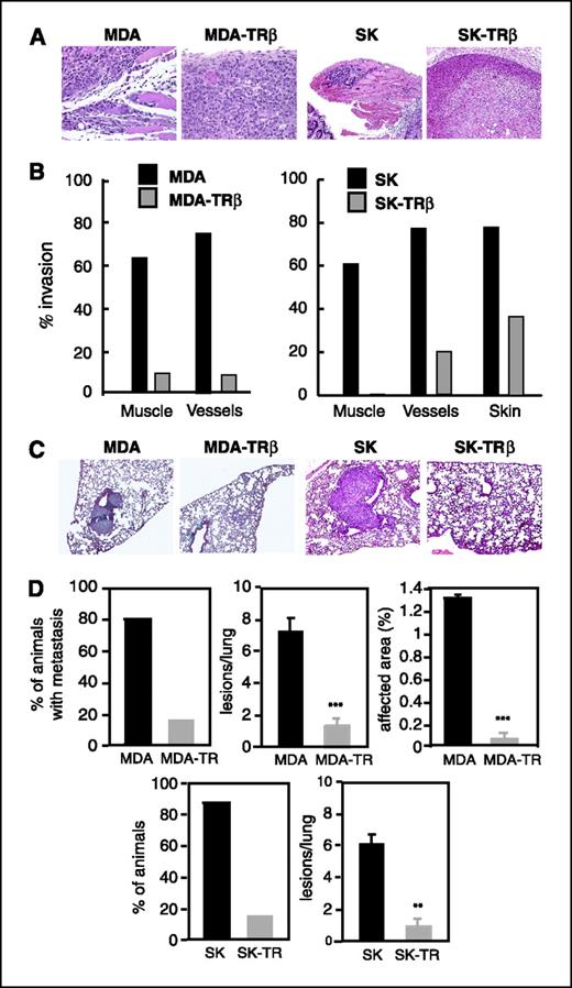 Figure 2. TRβ1 reduces tumor invasiveness and metastatic growth. A, representative H&E staining of tumors formed by parental and TRβ-expressing cells, showing that tumors originated from cells that express the receptor were less invasive. B, quantification of the percentage of tumors that infiltrated surrounding tissues, such as muscle, blood and lymph vessels, and skin. C, representative H&E of lungs from mice injected with parental and TRβ1-expressing cells 30 (for MDA cells) or 40 (for SK cells) d before into the tail vein. D, percentage of animals bearing metastatic lesions, number of lesions/lung, and area of lung parenchyma affected (mean ± SE).