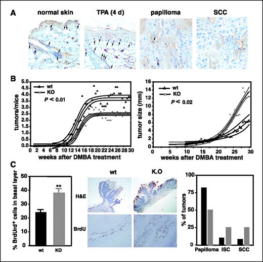 Figure 6. Role of TRs on chemical skin carcinogenesis in mice. A, TRβ expression is lost during progression of skin carcinogenesis. TRβ was detected by immunohistochemistry in normal skin, in skin of mice after 4 d of topical treatment with TPA (two applications of 12.5 μg), and in benign papillomas and SCC from mice subjected to the DMBA/TPA chemical skin carcinogenesis protocol. B, number and size of tumors during DMBA/TPA two-stage skin carcinogenesis comparing TRα−/−/TRβ−/− double KO animals with their wild-type (wt) controls. Triangles, wild-type; open circles, TRα−/−/TRβ−/−. The curves represent Bolzmann Sigmoidal nonlinear regression analysis of the data points. The respective 95% confidence intervals are expressed as flanking lines. C, the index of tumor proliferation (mean ± SE) represented by the average percentage of BrdUrd+ cells in the basal epithelial cell layer within representative end point skin tumors of KO and wild-type animals (left). Representative H&E staining and BrdUrd incorporation of chemically induced skin tumors in wild-type and TRα−/−/TRβ−/− mice (middle). Histologic classification of skin tumors at the end of the experiment. Columns, percentage of benign papillomas, in situ carcinomas (ISC), and SCC of TRα−/−/TRβ−/− and wild-type animals. Double KO tumors show a more malignant phenotype than wild-type counterparts (right).