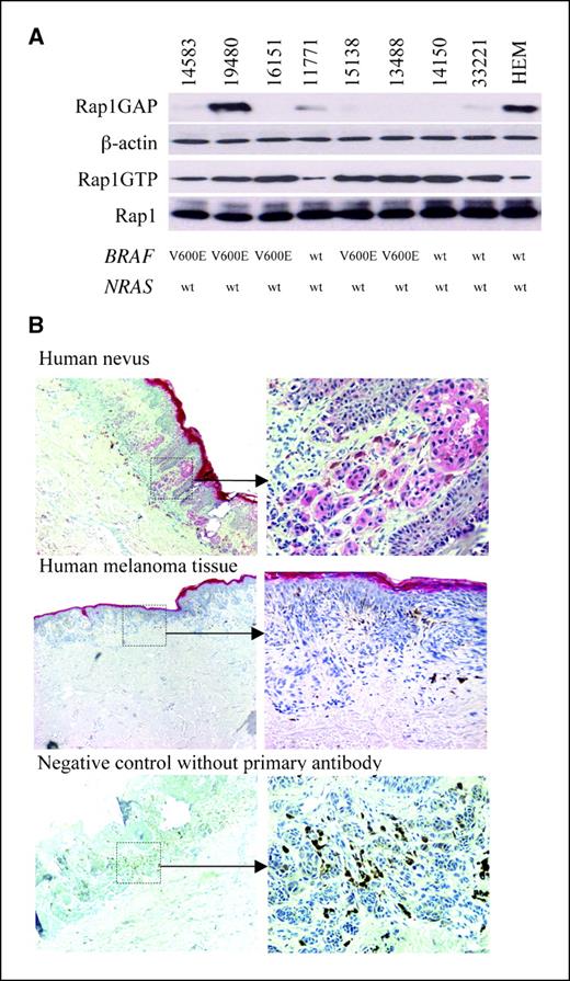 Figure 1. Decreased Rap1GAP protein expression in human melanoma tumors. A, protein was harvested from eight human melanoma tissues and HEMs and subjected to Western blot for Rap1GAP and pull-down assay for Rap1 activity. β-Actin served as internal control. DNA extracted from the same eight tumors and HEMs was sequenced for BRAF (exons 11 and 15) and NRAS (exons 2 and 3). The mutational status is listed under each sample, correspondingly. B, immunostaining for Rap1GAP was performed in human malignant melanoma and benign nevi. Top, left and right, positive staining (red) for Rap1GAP in the cytoplasm of nevus cells and upper epidermis. Middle, absence of Rap1GAP staining in human melanoma tumor cells with positive epidermal staining. Bottom, slides without primary antibody serve as negative control. Magnifications, 40× (left) and 200× (right).