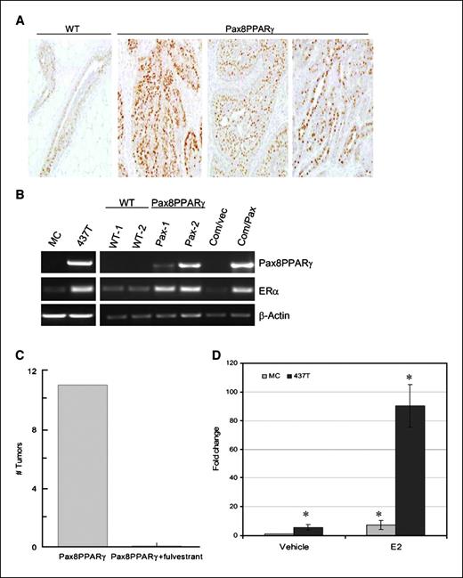 Figure 4. MMTV-Pax8PPARγ mice express ER+ adenocarcinomas after progestin/DMBA carcinogenesis. A, tumors from MMTV-Pax8PPARγ mice (Pax8PPARγ) exhibit strong ER expression in ductal adenocarcinomas versus the same tumor type from WT mice. Magnification, ×400. B, ER mRNA is up-regulated in the mammary gland and tumor cells from MMTV-Pax8PPARγ mice. RT-PCR reveals that ER mRNA is increased in 437T cells versus MC cells in mammary epithelial cells from MMTV-Pax8PPARγ mice (Pax-1 and Pax-2) versus WT mice (WT-1 and WT-2) and in Comma-1D cells transduced with Pax8PPARγ (Com/Pax) versus control cells (Com/vec). Pax8PPARγ and β-actin mRNA amplification were carried out for 30 cycles, and ER mRNA amplification for 38 cycles, to show the presence of ER mRNA in WT mammary gland and MC cells. C, fulvestrant inhibits carcinogenesis in MMTV-Pax8PPARγ mice. Following progestin/DMBA carcinogenesis as in A, animals were treated s.c. with either vehicle (Pax8PPARγ) or fulvestrant (Pax8PPARγ+fulvestrant) at a dose of 200 mg/kg once per week for 3 mo, and the number of mammary tumors was determined. n = 6 per group. D, ER-dependent reporter gene activity is increased in 437T cells. 437T and MC cells were grown in phenol red–free medium containing stripped serum for 24 h and transfected with ERE-luciferase. After 24 h, cells were treated with 10 nmol/L 17-β-estradiol (E2), and reporter gene activity was determined 24 h later in 437T cells (black columns) and MC cells (gray columns). Reporter activity is significantly increased by E2 in 437T and MC cells, and reporter activity in the absence or presence of E2 is significantly greater in 437T cells versus MC cells. Columns, mean (n = 3 per assay); bars, SE. *, P < 0.001 by Student's t test.