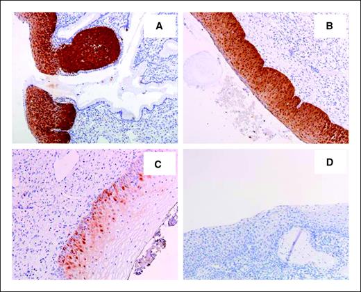 Figure 1. Representative examples of p16INK4a immunostaining results in CIN2/3 lesions and CIN1 lesions. Positive results for CIN2/3 lesions HGCIN24 and HGCIN39 are shown in A and B, respectively. In C and D, a positive CIN1 lesion, LGCIN1, and a negative CIN1 lesion, LGCIN6, are depicted, respectively. All pictures were taken using a ×10 magnification.