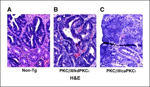 Figure 2. PKCι/λ drives adenoma to carcinoma progression in AOM-induced colon tumors. Representative sections of tumors from nontransgenic (A), PKCβII/dnPKCι (B), and PKCβII/caPKCι (C) mice were stained with H&E. Nontransgenic and PKCβII/kdPKCι mice develop primarily adenomas that retain crypt-like architecture and epithelial cell polarity. In contrast, tumors from PKCβII/caPKCι mice are often carcinomas characterized by loss of crypt organization and polarity, and formation of disorganized sheets of transformed tumor cells. NS, not significant.