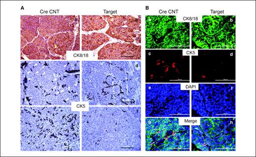 Figure 3. Ablation of FAK depleted a subset of basal cells that coexpress luminal and basal markers in the tumors of Target mice. A, sections from the primary tumor of CreCNT (a, c, e) and Target (b, d, f) mice were analyzed by immunohistochemistry using antibodies against CK8/18 (a, b) and CK5 (c–f). c, arrows mark clusters of basal cells in the periphery of tumor nodules of CreCNT mice in early carcinoma stage and arrowheads mark basal cells present in the tumor nodules. e and f, sections of tumor of CreCNT and Target mice, respectively, in late carcinoma stage. Scale bars, 200 μm. B, sections from the primary tumor of CreCNT (a, c, e, g) and Target (b, d, f, h) mice were analyzed by double labeling immunofluorescence using antibodies against CK8/18 and CK5. g and h, arrows indicate bipotent cells with coexpression of both markers. Scale bars, 200 μm.