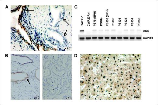 Figure 6. ASS expression in prostate tissue. A, prostate cancer tissue with ASS(+) benign glands (closed arrows) and ASS(−) cancerous glands (open arrows) by immunohistochemistry. B, left, normal prostate tissue. Closed arrows, luminal ASS staining. Right, prostate cancer tissue with no ASS reactivity. C, mRNA from primary prostate tissue was examined for ASS expression by RT-PCR. D, normal liver as a positive control for cytoplasmic ASS staining. BPH, benign prostatic hyperplasia.
