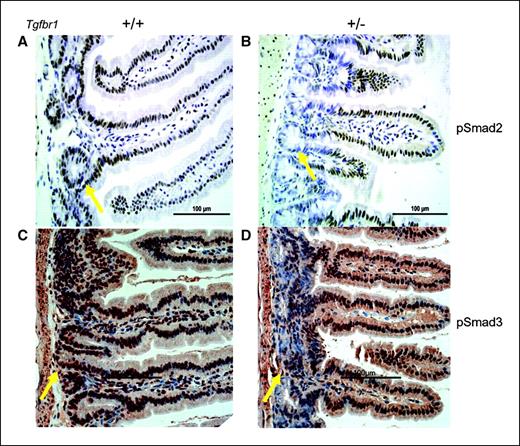 Figure 5. Immunohistochemistry staining patterns of normal-appearing small bowel tissues from ApcMin/+;Tgfbr1+/+ and ApcMin/+;Tgfbr1+/− mice. A and B, normal-appearing small intestine stained with pSmad2 shows identical staining pattern throughout the villi of both ApcMin/+;Tgfbr1+/+ mice (A) and ApcMin/+;Tgfbr1+/− mice (B). However, pSmad2 staining within the intestinal crypts of ApcMin/+;Tgfbr1+/− mice (arrow) is reduced when compared with that of their wild type counterparts (arrow). C and D, normal-appearing small intestine stained with pSmad3 shows identical staining pattern throughout the villi of both ApcMin/+;Tgfbr1+/+ mice (C) and ApcMin/+;Tgfbr1+/− mice (D). However, pSmad3 staining within the intestinal crypts of ApcMin/+;Tgfbr1+/− mice (arrow) is reduced when compared with that of their wild type counterparts (arrow).
