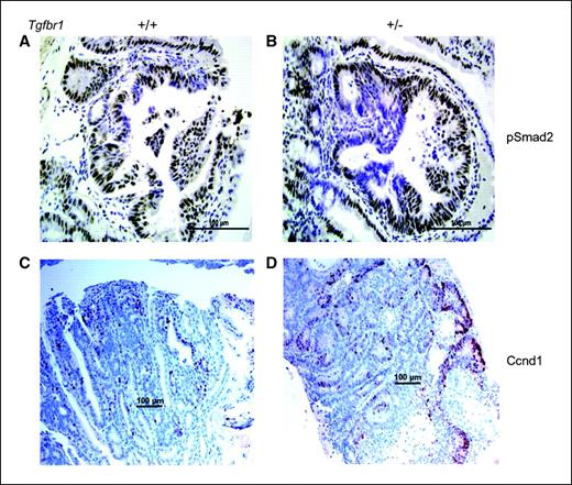 Figure 6. Characterization of Tgfbr1 haploinsufficiency on molecular signaling within tumors. A and B, pSmad2 staining is patchy within tumors arising from ApcMin/+;Tgfbr1+/− mice, which reflects focally decreased Smad-mediated TGF-β signaling (B), whereas tumors arising from ApcMin/+;Tgfbr1+/+ mice have uniform pSmad2 staining showing preserved Smad-mediated TGF-β signaling (A). C and D, Ccnd1 (cyclin D1) expression is significantly higher in the tumors of ApcMin/+;Tgfbr1+/− mice (F, 50.7 ± 4.1% positive staining) than in those of ApcMin/+;Tgfbr1+/+ mice (E, 20.1 ± 5.7% positive staining), P = 0.002.
