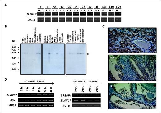 Figure 1. Overexpression of ELOVL7 in prostate cancer cells and regulation of ELOVL7 expression. A, semiquantitative RT-PCR analysis of ELOVL7 in prostate cancer cells (T) and normal prostatic epithelial cells (N) that were microdissected from 10 prostate cancer tissues. Horizontal lines, clinical N/T pair cases. ACTB (β-actin) was used to quantify each of cDNA contents. B, multiple tissue Northern blot analysis showed that ELOVL7 was strongly expressed in the prostate, kidney, pancreas, and adrenal gland. C, immunoreactivity with anti-ELOVL7 antibody was observed in prostate cancer tissues, exhibiting strong positive immunostaining in the cytoplasm of prostate cancer cells (top), whereas a weak immunopositivity was observed in PIN precursors (middle) and noncancerous prostate epithelium (bottom). D, semiquantitative RT-PCR showed that androgens stimulated ELOVL7 expression as well as prostate-specific antigen (PSA) in LNCaP cells (left). RPL3 was used to normalize each expression. Semiquantitative RT-PCR showed that knockdown of SREBP1 (siSREBP1) decreased ELOVL7 expression in LNCaP cells (right). ACTB was used to normalize each expression.