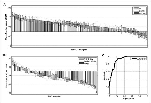 Figure 1. Classification scores assigned by the NSCLC classifier to 137 NSCLC patients and 91 patients with nonmalignant lung disease. A positive score indicates classification as a cancer; a negative score as a nonmalignant disease. The column heights are a measure of how well the sample is classified by the SVM algorithm for the 29 genes and the error bars are a measure of the classification variance across the 100 resamplings. A, NSCLC patients: AC, adenocarcinoma; LSCC, lung squamous cell carcinoma; NSCLC, samples not further characterized. B, NHCs include patients with nonmalignant lung disease: COPD, only COPD; Benign nodules, determined by biopsy; other, various types of lung diseases. C, receiver-operator characteristic curve for classification of samples shown in A and B. AUC, area under the curve. White circle, sensitivity-specificity value corresponding to classification score threshold of 0.