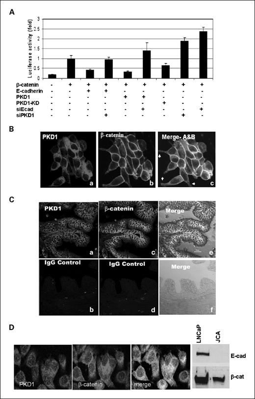 Figure 1. PKD1 associates with β-catenin and negatively regulates β-catenin/TCF transcription activity. A, both PKD1 and E-cadherin negatively regulate β-catenin/TCF transcription activity (Topflash assay). Fifty nanograms of Topflash plasmid, 2.5 ng of Renilla luciferase, and 50 ng of wild-type β-catenin were cotransfected with 100 ng of PKD1, kinase-dead PKD1, or E-cadherin constructs, or with 25 ng of shRNA constructs against either E-cadherin (siEcad) or PKD1 (siPKD1) into NIH 3T3 cells. Firefly luciferase activities were measured 48 h after transfection with Promega dual reporter assay reagents and the firefly luciferase activity was normalized by Renilla luciferase activity. Overexpression of PKD1 or E-cadherin inhibits β-catenin transcription activity. In contrast, knockdown of either PKD1 or E-cadherin by siRNA increases β-catenin transcription activity. Knockdown of PKD1 relieves the inhibitory effects caused by overexpression of β-catenin and vice versa. Bars, SD based on triplicate samples. The efficacy of these shRNA constructs was shown in ref. 20. B to D, colocalization and in vivo association of PKD1 and β-catenin. B, PKD1 and β-catenin mainly colocalize on plasma membrane in LNCaP cells, which are E-cadherin positive. C, PKD1 and β-catenin colocalize in normal prostate tissue. D, PKD1 and β-catenin mainly colocalize in cytosol in bladder cancer JCA cells, which are E-cadherin negative.