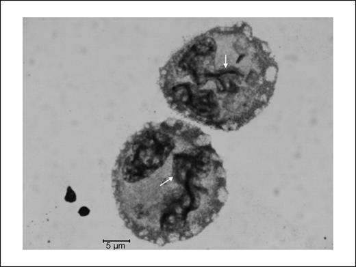 Figure 3. Morphologic features reminiscent of synaptonemal complexes in irradiated HeLa S3 cells. Photomicrographs of HeLa S3 cells at 7 d post-10 Gy of γ-irradiation. White arrows, morphologic features reminiscent of the meiotic synaptonemal complexes; bar, 5 μm (cytospin preparations).