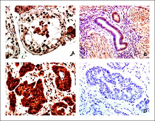 Figure 5. Immunohistochemistry of paraffin-embedded cervical cancer tissue with DMC1 antibody. Tissue sections were pretreated with proteinase K and incubated with DMC1 antibody (1:200 dilution; Abcam). Secondary antibody, Dako Envision+ System–labeled polymer-HRP, anti-mouse; counterstaining, hematoxylin (Surgipate). A, human normal testis specimen, positive control; B, human lower uterine segment, normal specimen; C, human adenocarcinoma of the cervix; D, human adenocarcinoma of the cervix, negative control, same specimen as in C. Magnification, ×40.