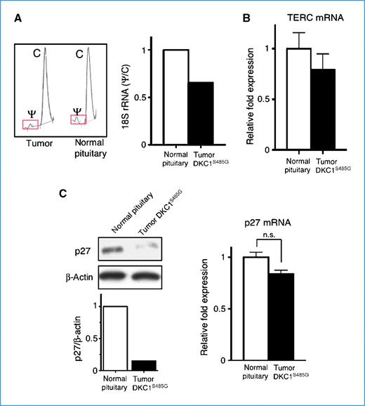 Figure 5. Impaired rRNA pseudouridylation is associated with reductions of p27 protein levels but not of the telomerase RNA component (TERC) in the DKC1S485G mutant tumor. A, chromatographs of high-performance liquid chromatography analysis of the 18S rRNA pseudouridylation. Bar graph shows quantification of the ψ/C ratio in samples from normal pituitary and the DKC1S485G mutant tumor. B, the levels of TERC were measured by quantitative PCR in two normal pituitaries and the DKC1S485G pituitary tumor. Analysis was performed in triplicate on two different samples per specimen. No significant differences between the samples were found. P > 0.05 was determined using the unpaired two-tailed t test. C, p27 protein levels are markedly reduced in the tumor carrying the DKC1S485G mutation. Western blot (left) and quantitative PCR analysis (right) of p27 expression were performed using protein extracts and total RNA prepared from a normal pituitary and the tumor carrying the DKC1S485G mutation. Densitometric analysis of p27 over β-actin levels is shown (bottom left). No significant differences in p27 mRNA levels were measured between the samples. P > 0.05 was determined by employing the unpaired two-tailed t test.