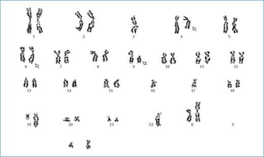 Figure 2. Karyotype of the T38 CAF. A representative karyotype from 1 of 38 metaphases analyzed for T38 CAF. Harvesting, metaphase preparation, and cytogenetic analysis with a trypsin-Giemsa banding technique were performed according to standard cytogenetic procedures. Note that the q arm of chromosome 4 is shortened and that one of the p arms of chromosome 9 is missing. Chromosome 6 seems to show a difference between the two chromosomes. Note also other changes such as missing chromosomes 3, 16, 17, and 22, as well as shortened chromosomes 5, 19, and X.
